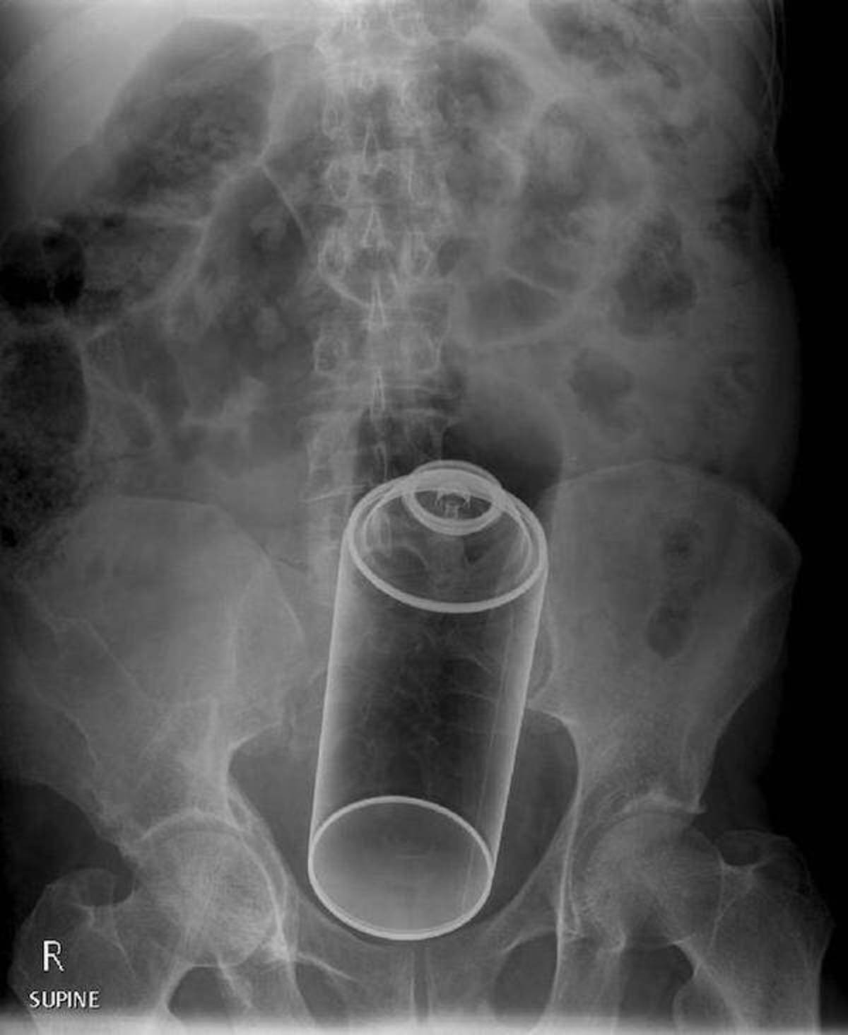 Рентген снимки с инородными телами в прямой кишке